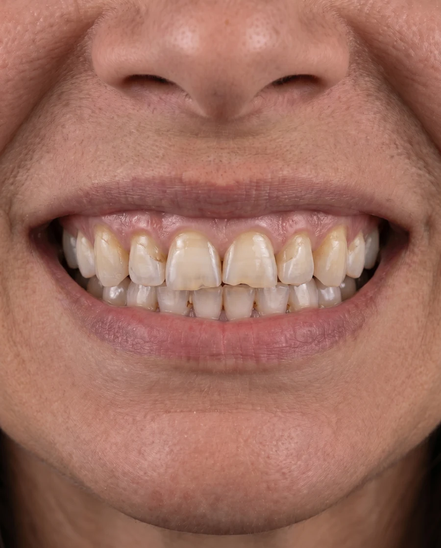 Rehabilitación oral completa — antes